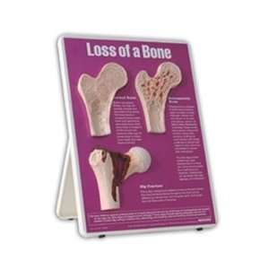  Loss of a Bone Easel Display: Arts, Crafts & Sewing