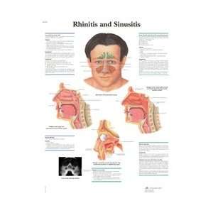 Rhinitis and Sinusitis   Anatomical Chart  Industrial 