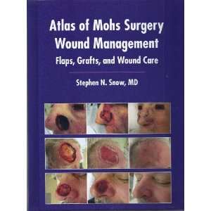  Atlas of Mohs Surgery Wound Management Flaps, Grafts, and 